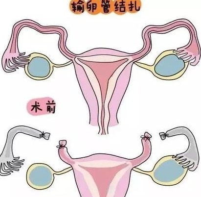 多囊卵巢综合征做泰国试管费用是多少？